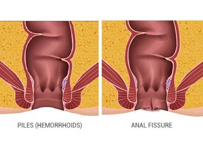 Best Ayurvedic Clinic for Piles, Fissures in Pimpri Chinchwad