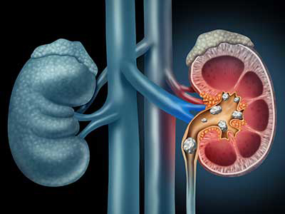 Ayurvedic Doctor for Kidney Stones in Nigdi | Sanjeevan Ayurveda & Panchakarma