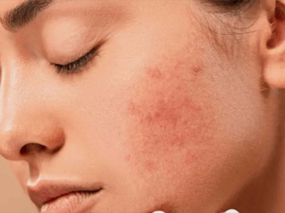 Ayurvedic Doctor for Skin Disease in Jadhavwadi | Sanjeevan Ayurveda & Panchakarma