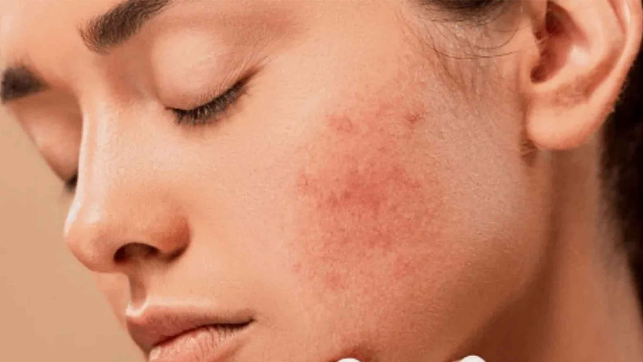 Chronic Skin Diseases